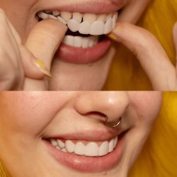 لمینت دندان دو فک مدل TruSmile (اورجینال)